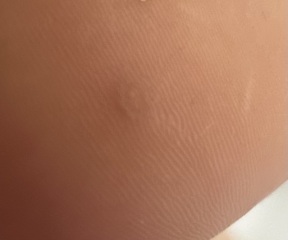 Does these look like verrucas?