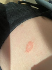 Teen daughter full body rash