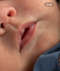 Red spots appearing on baby face?