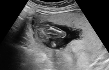 16 week gender scan