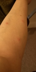 AIBU to ask if these are bed bug bites?