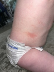 Hives - true allergy or not