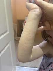 Rash on dd’s forearm