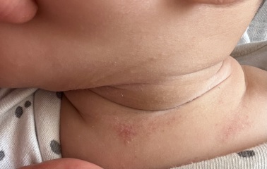 is this eczema and what can i do about it?