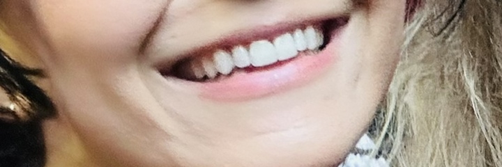 Can you tell me about your composite bonding please?