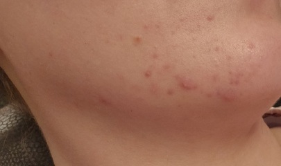Acne at 30
