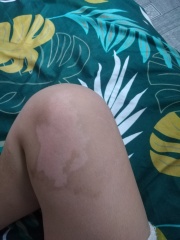 Will this 2nd degree burn leave a scar?