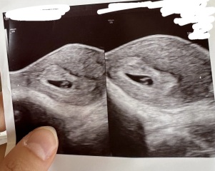 First pregnancy scan