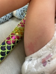 Daughters itchy palms for 2 weeks