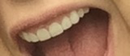 Can you tell me about your composite bonding please?