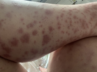 Random rash and bruises