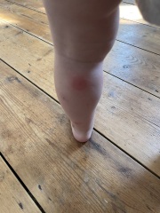 Advice please on mosquito bite