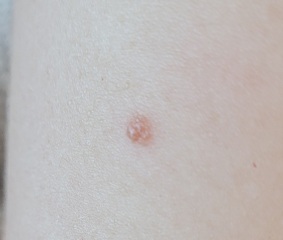 Do you think this mole needs checking