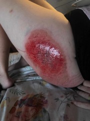 Gravel Burns - Warning Pics included