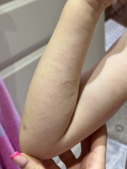 Rash on dd’s forearm