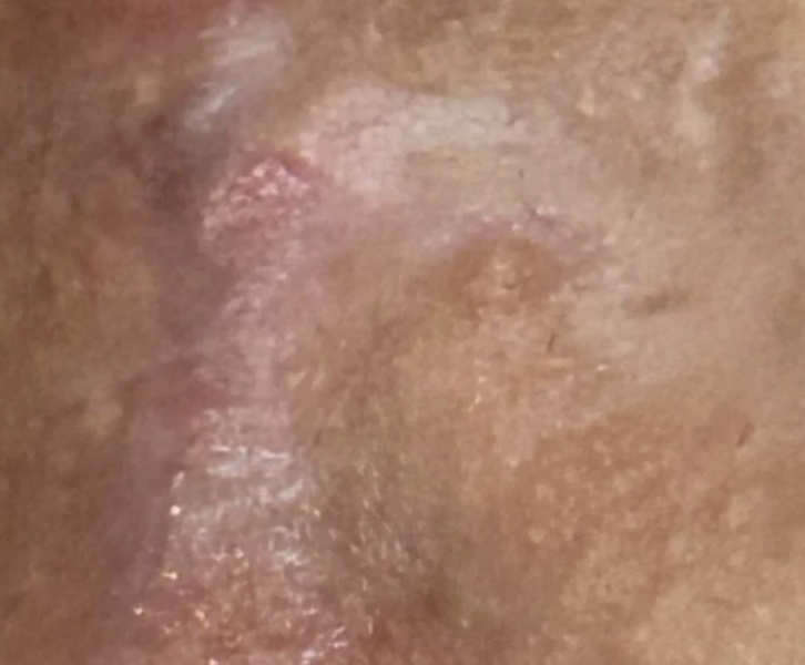 Butchered episiotomy