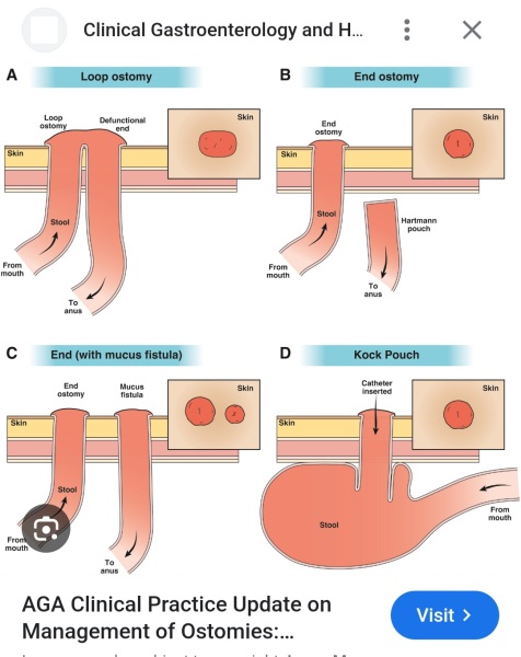 I have a stoma - AMA