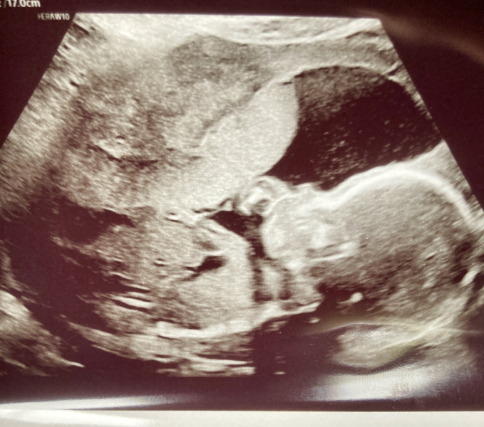 BFP after IVF - the journey continues (part 2)