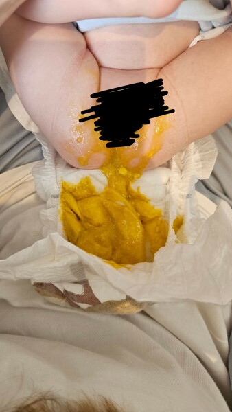 Is this normal breastfed baby poo? (warning: poo pic attached)