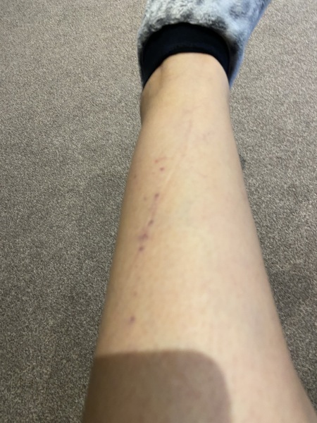Small purple dots on shin