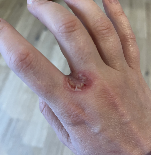 Dyshidrotic eczema/pompholyx - infected