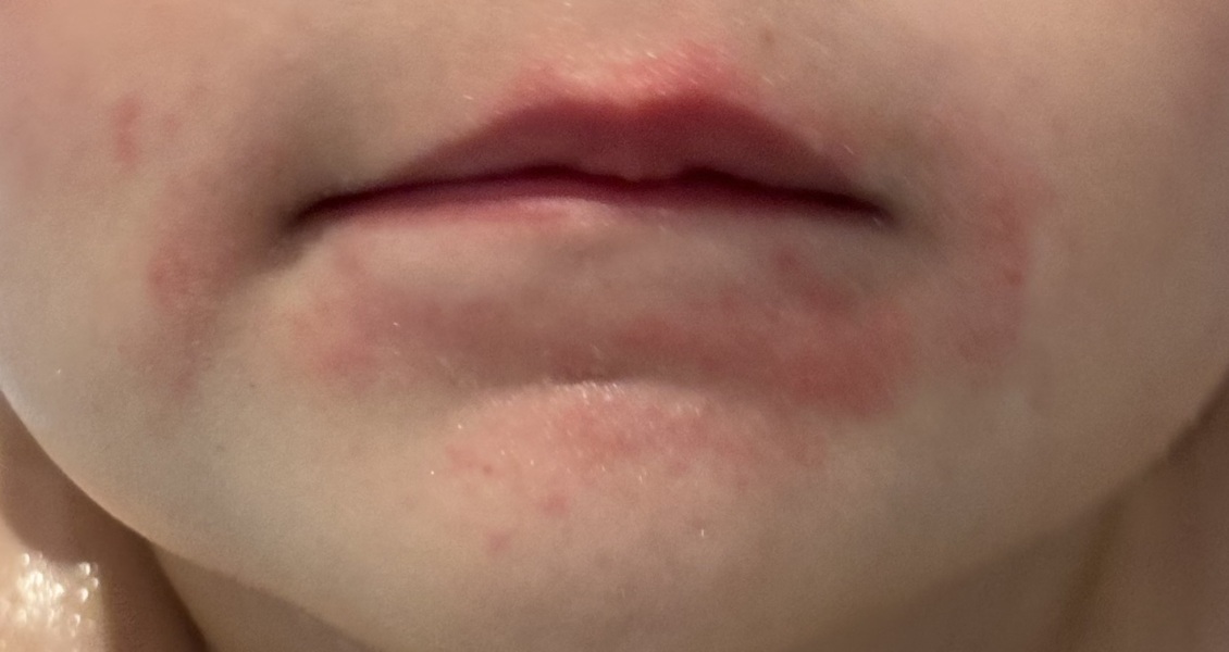 Child red rad around mouth - pic included