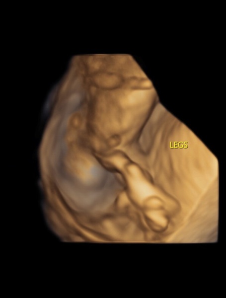 Boy or Girl? 12 week scan