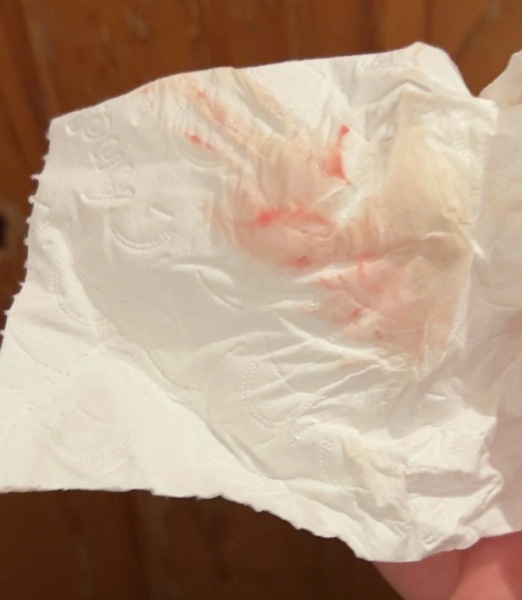 Implantation bleeding (pic)