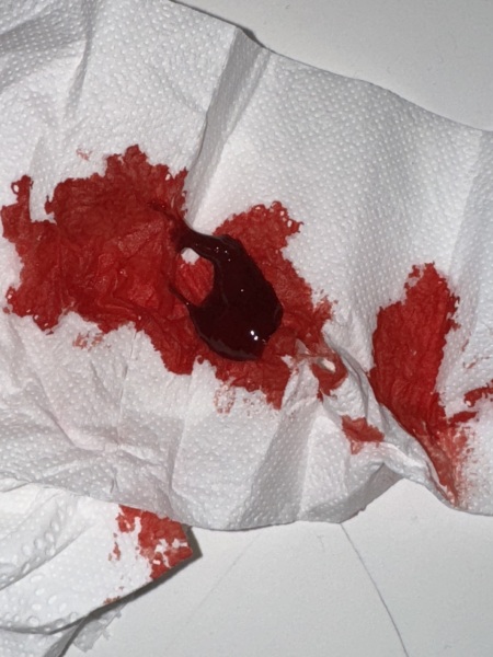 6 weeks pregnant - is this a miscarriage?