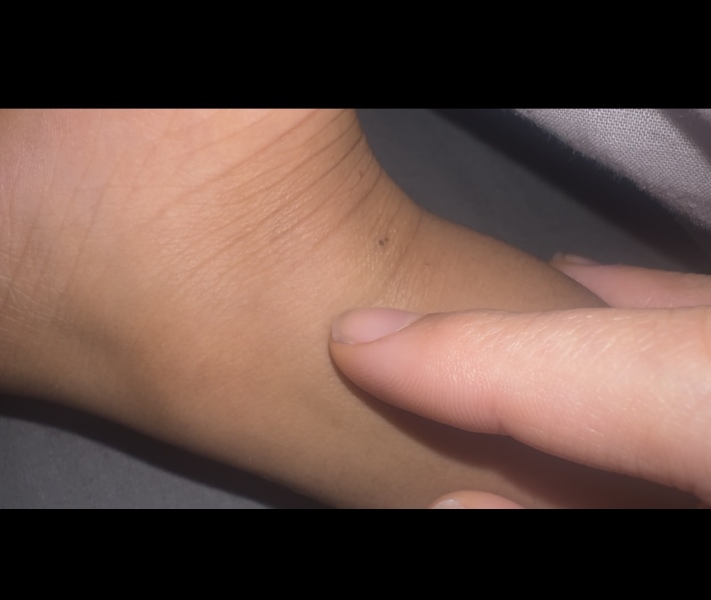 Small spots on child’s feet have turned dark