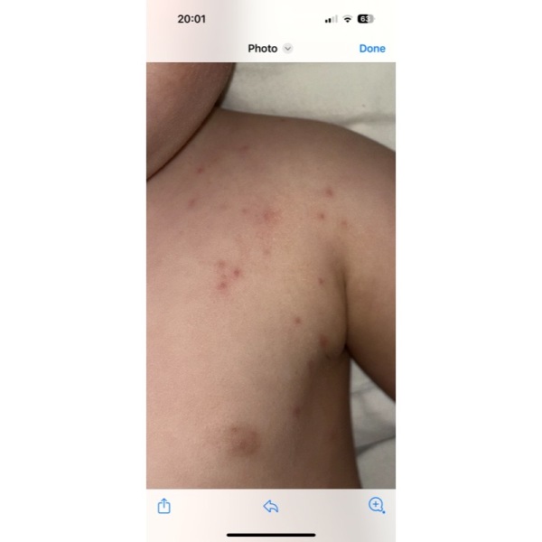 Is this chicken pox?