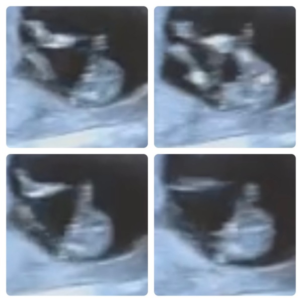12 week scan boy or girl?