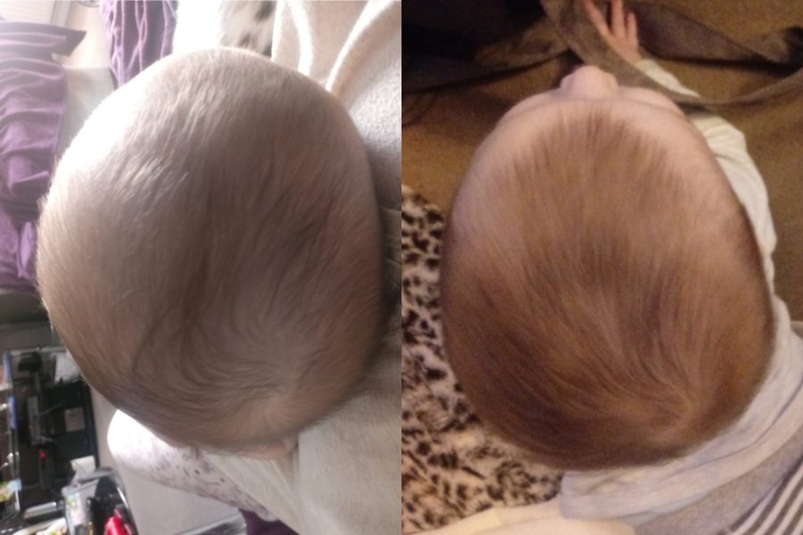 Does plagiocephaly truly get better by itself?