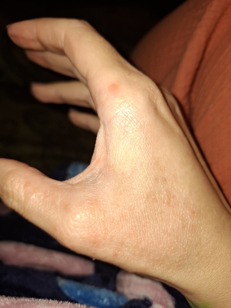 Hand infected (Warning, gross photos)