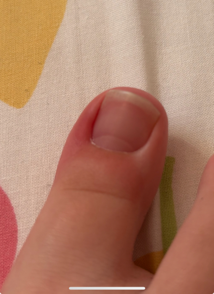 Ingrown toe nail