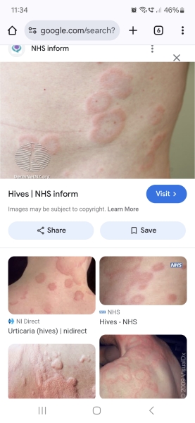 Any idea what this rash is on DS?