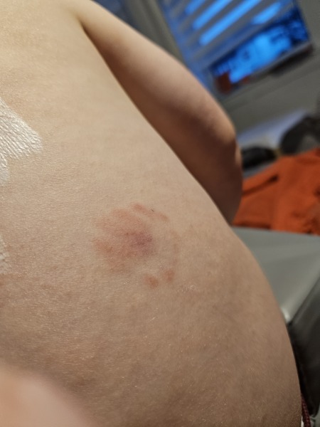 Ringworm or bite?
