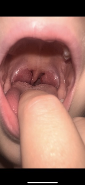 Does this look like tonsillitis?
