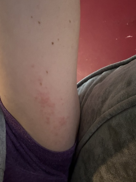 Any idea what this rash could be?