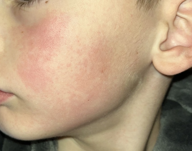 Is this slapped cheek?