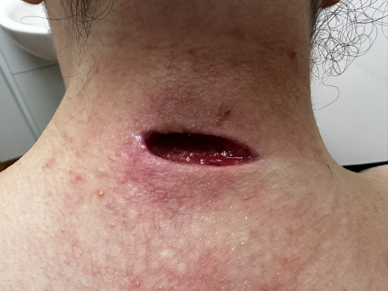 Mother of all sebaceous cysts