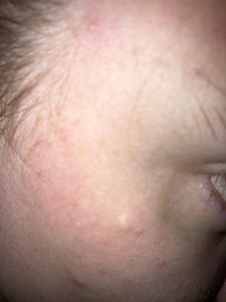 Lump under skin on face