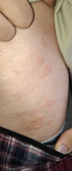 Any idea what this rash is on DS?