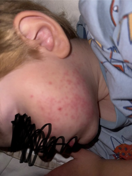 What is this rash?