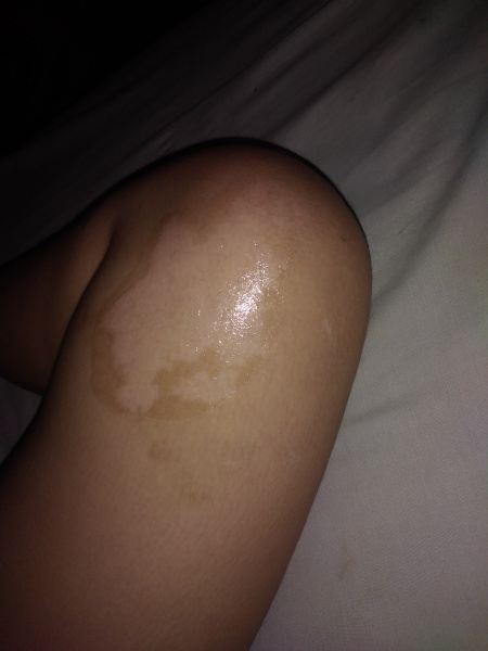WILL THIS TURN INTO HYPOPIGMENTED SCAR?