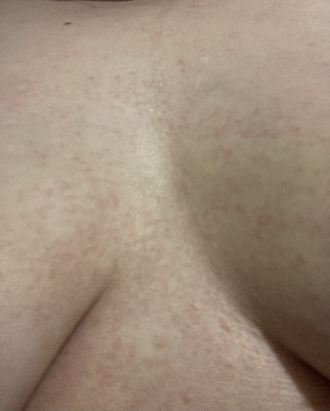 Between boobs sweat itch