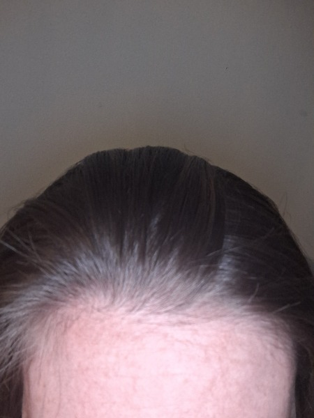 Losing hair on hairline