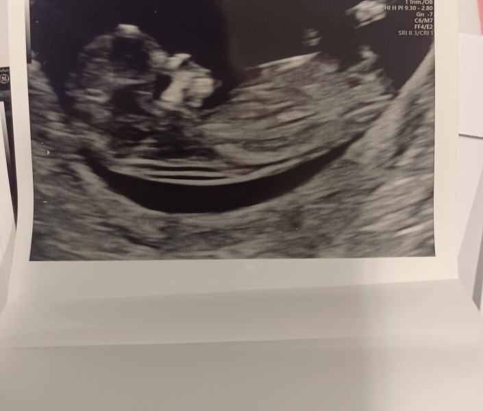 13 WEEKS PREGNANT NUB THEORY