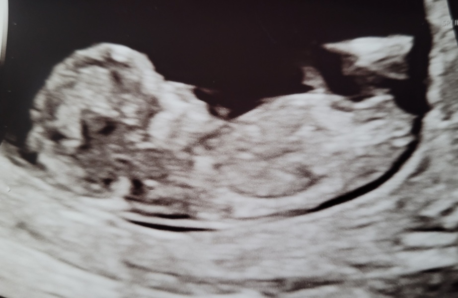 Any guesses girl or boy? 💗💙