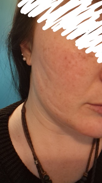 I had laser treatment for rosacea today but I've just noticed indentations on my cheeks.